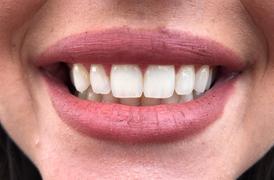 PurelyWHITE Deluxe Teeth Whitening Kit Review