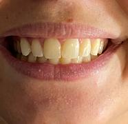 PurelyWHITE Deluxe Teeth Whitening Kit Review