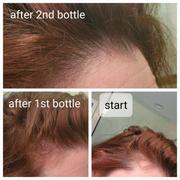 Kerotin Intensive Hair Growth Drops - 3 Month + Free Gift Review