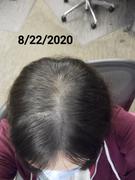 iRestore Hair Growth System iRestore Professional Review