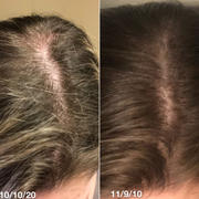 iRestore Hair Growth System iRestore Professional Review