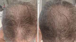 iRestore Professional – Laser Hair Growth System, FDA Cleared ...