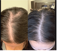 iRestore Hair Growth System iRestore Essential Review