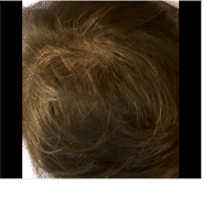 iRestore Hair Growth System iRestore Essential Review