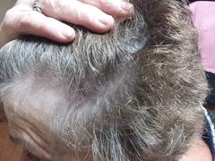 ScalpMED® PATENTED HAIR REGROWTH SYSTEM FOR WOMEN Review