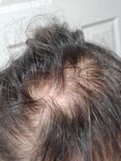 North Authentic Hair Loss With Oily Scalp ECHO System Review