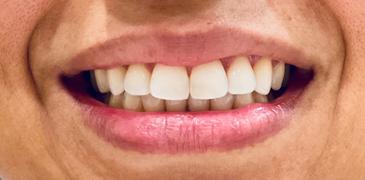 ELIMS Magic Melt-Away Teeth Whitening Masks Review