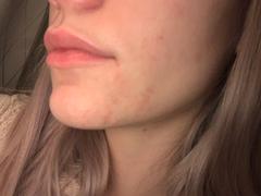 Coréelle The Acne Relief Set Review