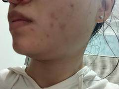 Coréelle The Acne Relief Set Review