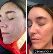 Epiluxe Skin  Review