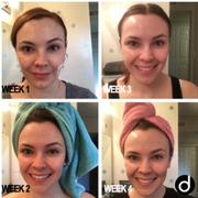 Dermay DERMA MASK™ - Smart & Portable Red Light Therapy Mask Review