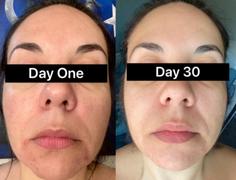 Dermay DERMA MASK™ - Smart & Portable Red Light Therapy Mask Review
