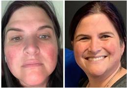 Dermay DERMA MASK™ - Smart & Portable Red Light Therapy Mask Review