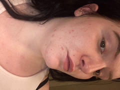 SKINKISSED™ Facial Cleanser Review