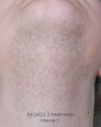 RoseSkinCo US Lumi - IPL Hair Removal Handset Review
