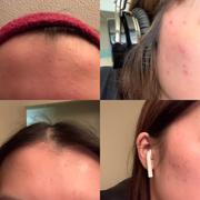 aprilskin.us Carrotene Trouble-Free Kit (with FREE Minis) Review