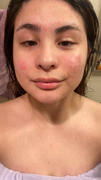 aprilskin.us Carrotene Trouble-Free Kit (with FREE Minis) Review