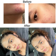 aprilskin.us Carrotene Trouble-Free Kit (with FREE Minis) Review