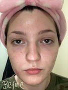 aprilskin.us Carrotene Trouble-Free Kit (with FREE Minis) Review
