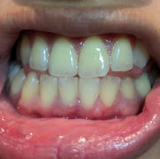 Holo 2-Pen Holo Teeth Whitening Kit Review