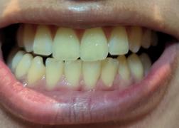 Holo 2-Pen Holo Teeth Whitening Kit Review