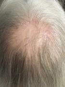 iRESTORE Laser REVIVE Hair Growth Formula Review