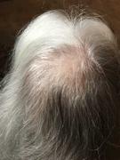 iRESTORE Laser REVIVE Hair Growth Formula Review