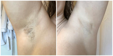 lanveza Lanveza™ IPL Laser Hair Removal Handset Review