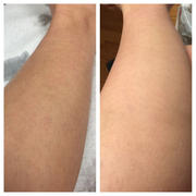 lanveza Lanveza™ IPL Laser Hair Removal Handset Review