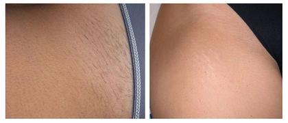 lanveza Lanveza™ IPL Laser Hair Removal Handset Review