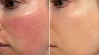 lanveza Lanveza LED Beauty Mask Review
