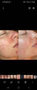 Skin O2 Salicylic Acid Serum Review