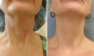 BelleGlory® Ultrasonic Cavitation Handset™ 6-in-1 Slimming & Beautifying Device Review
