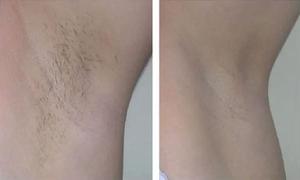 luvenashop Luvena™ IPL Laser Permanent Hair Removal Review