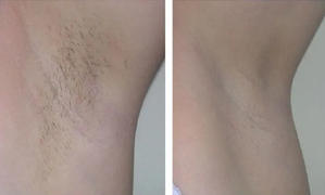 luvenashop Luvena™ IPL Pro  Permanent Hair Removal Review