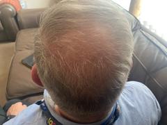 hair growth bundle