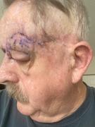 Particle Particle Scar Gel Review