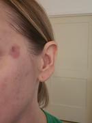 30% TCA At Home Adjustable Peel