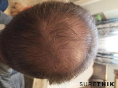 SureThik Canada Hair Fiber Value Package (20% Savings) Review