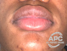 APC 5% Cysteamine Cream