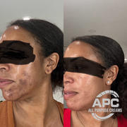 APH Hydroquinone Cream - All Purpose Creams