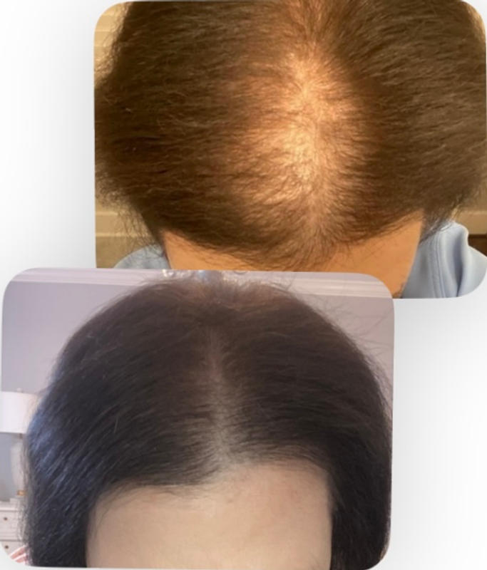 Laser Hair Growth Helmet Laser Hair Growth Device 3 Gears For Treating  Hereditary Alopecia  Fruugo IN