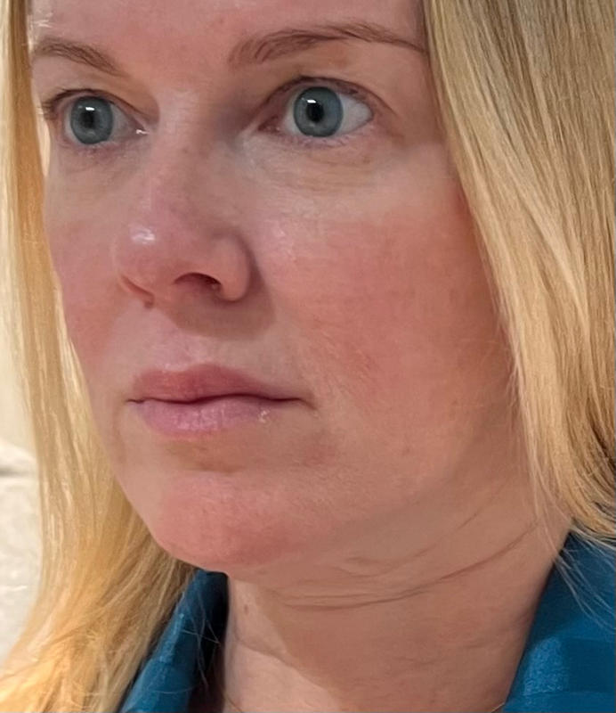 Blue Colour Contacts Capri Blue Dimple Dimple Color