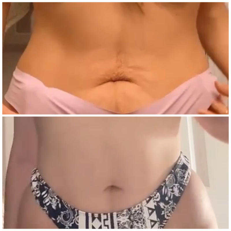 Before and After Benefits of Body Sculpting : r/BodyContour