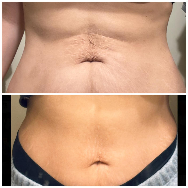 Before and After Benefits of Body Sculpting : r/BodyContour