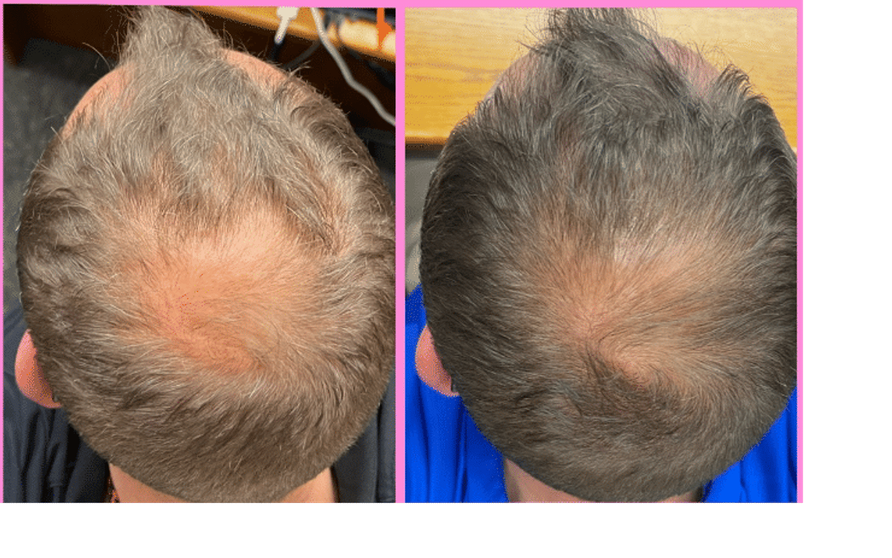 iRESTORE Professional Best Selling Hair Growth Device FDA Cleared