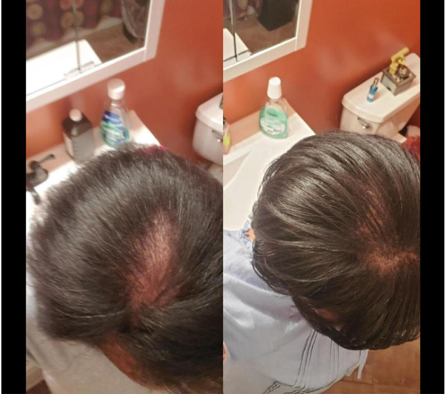 iRESTORE Professional Best Selling Hair Growth Device FDA Cleared