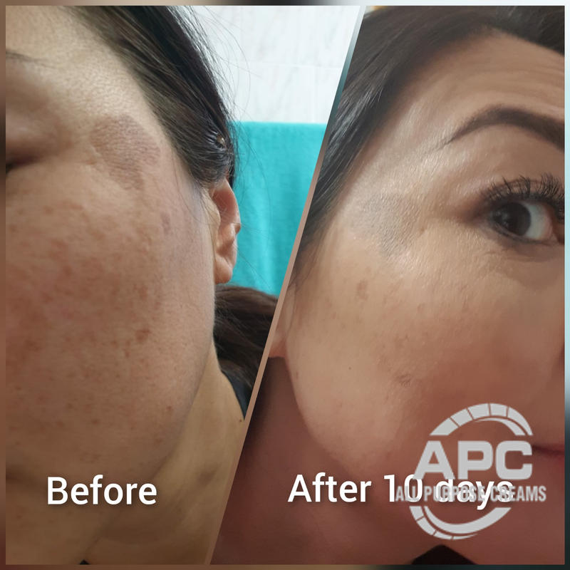 5% Cysteamine Cream - Only Target Hyperpigmentation – All Purpose