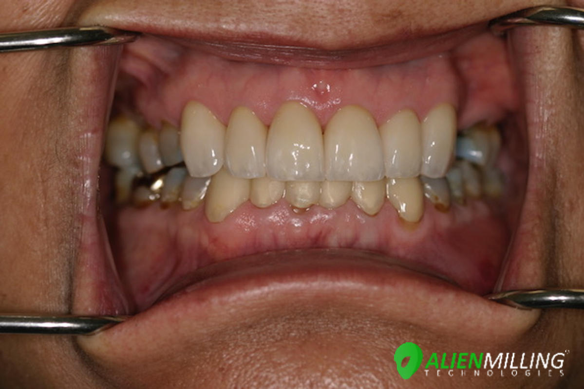 Alien Extreme Translucency Zirconia Block 98mm Disk PreShaded