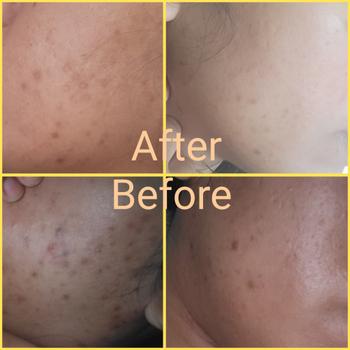 aprilskin.com.sg Carrotene Pimple Stopper Review